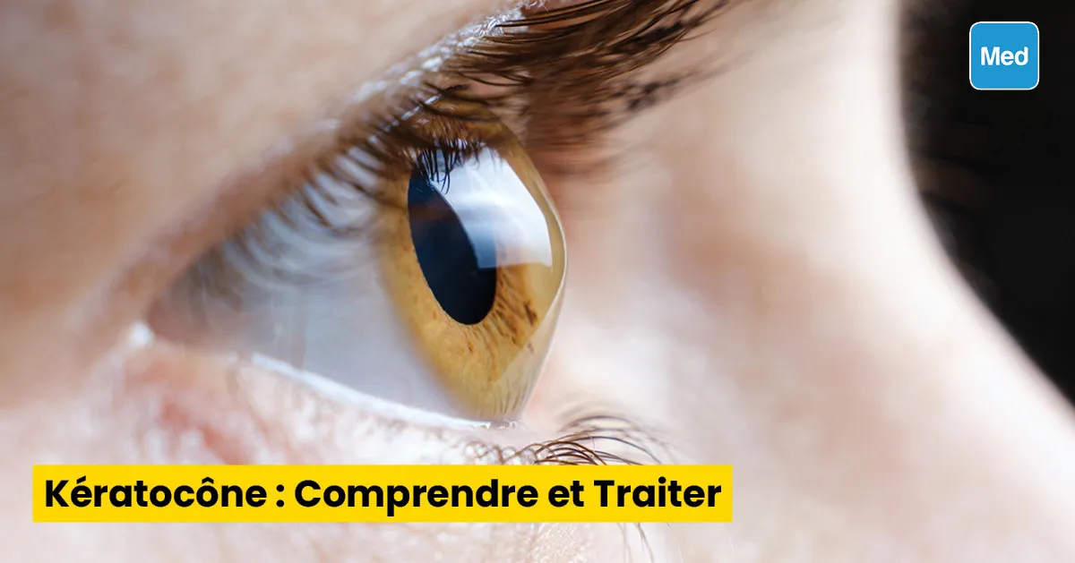 Kératocône : Comprendre et Traiter